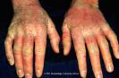 eczema